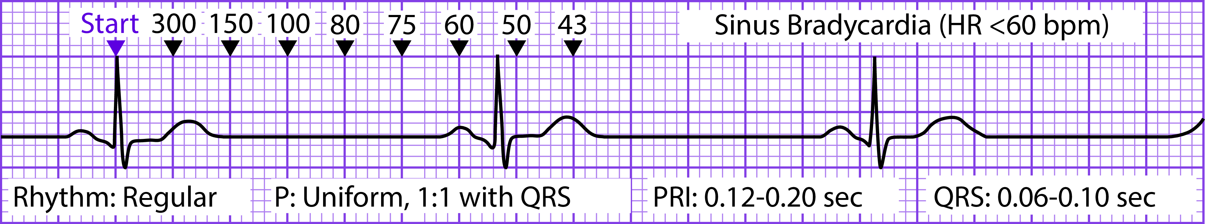 Atrial Dysrhythmias Diseases and Disorders