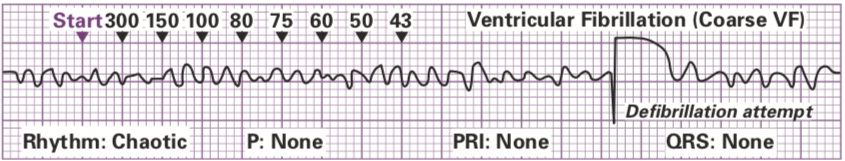 Ventricular Dysrhythmias Diseases And Disorders