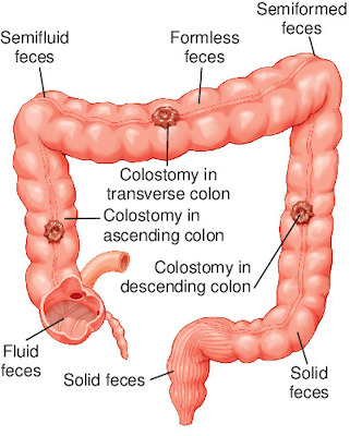 colostomy | Taber's Medical Dictionary