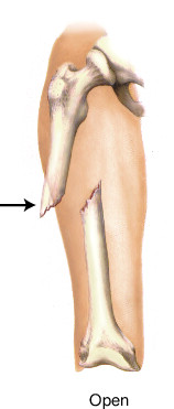 fracture | Taber's Medical Dictionary