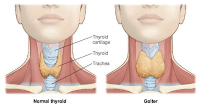 goiter | Taber's Medical Dictionary