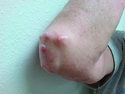 nodule | Taber's Medical Dictionary