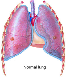 pneumothorax | Taber's Medical Dictionary