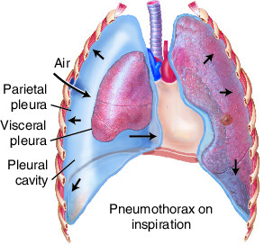 pneumothorax | Taber's Medical Dictionary