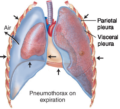 pneumothorax | Taber's Medical Dictionary
