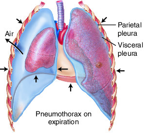 pneumothorax | Taber's Medical Dictionary