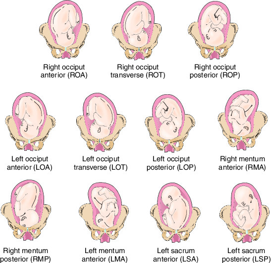 transverse or oblique presentation of fetus
