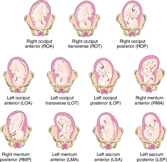 attitude of fetus in breech presentation