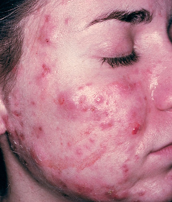 acne | Taber's Medical Dictionary