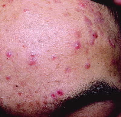 acne | Taber's Medical Dictionary