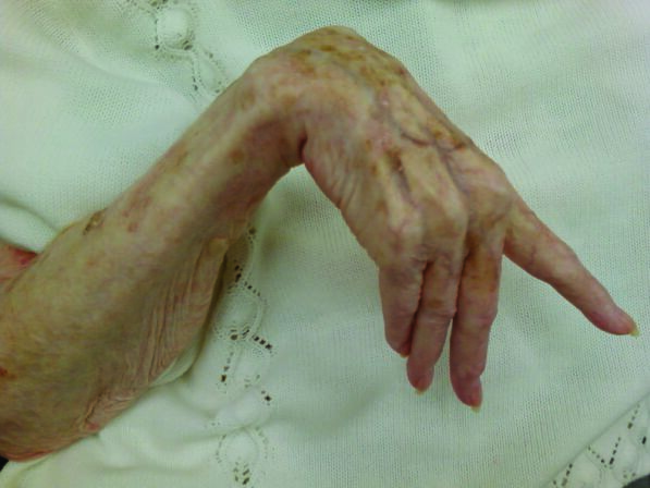 Contracture Taber s Medical Dictionary
