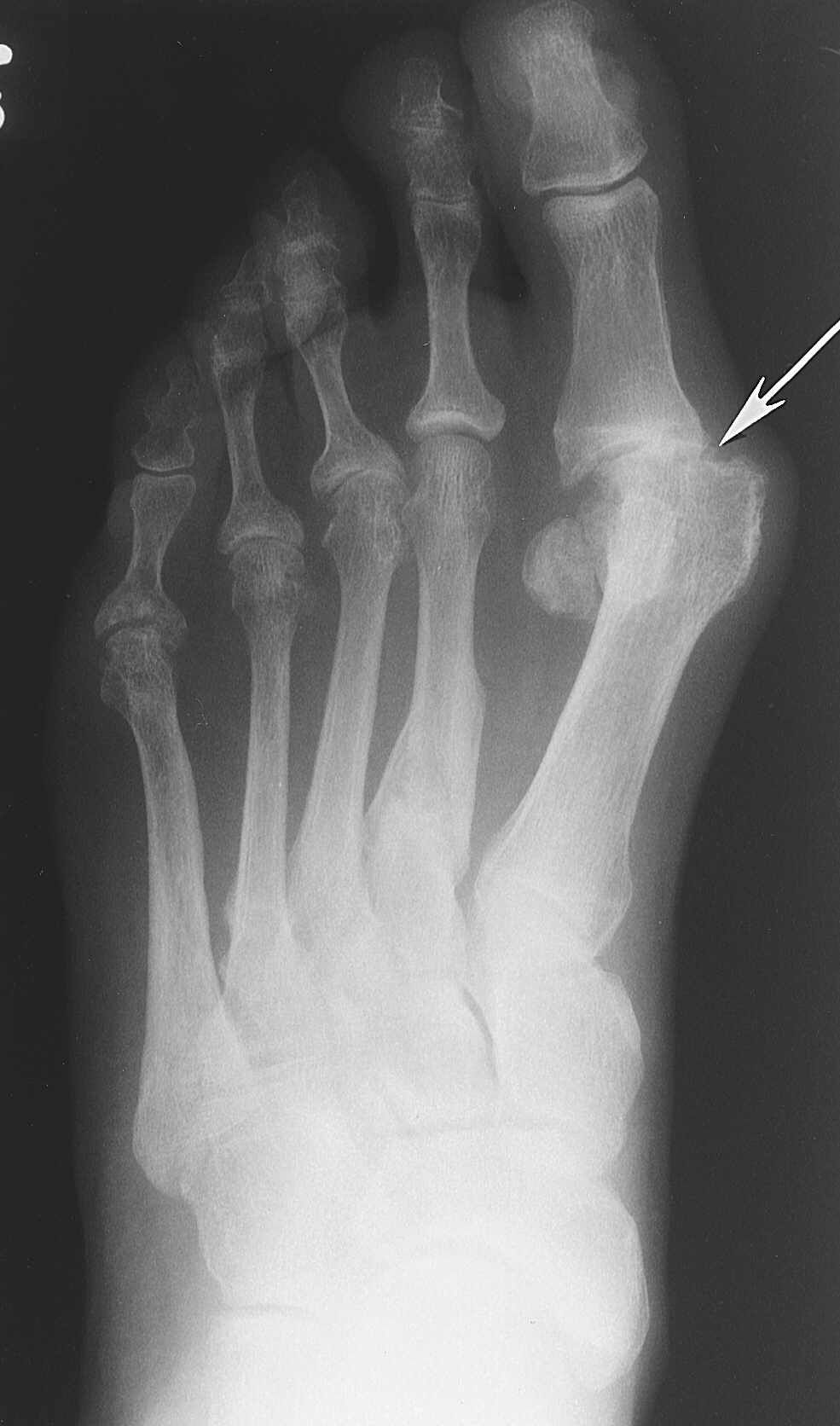 arthritis Taber's Medical Dictionary