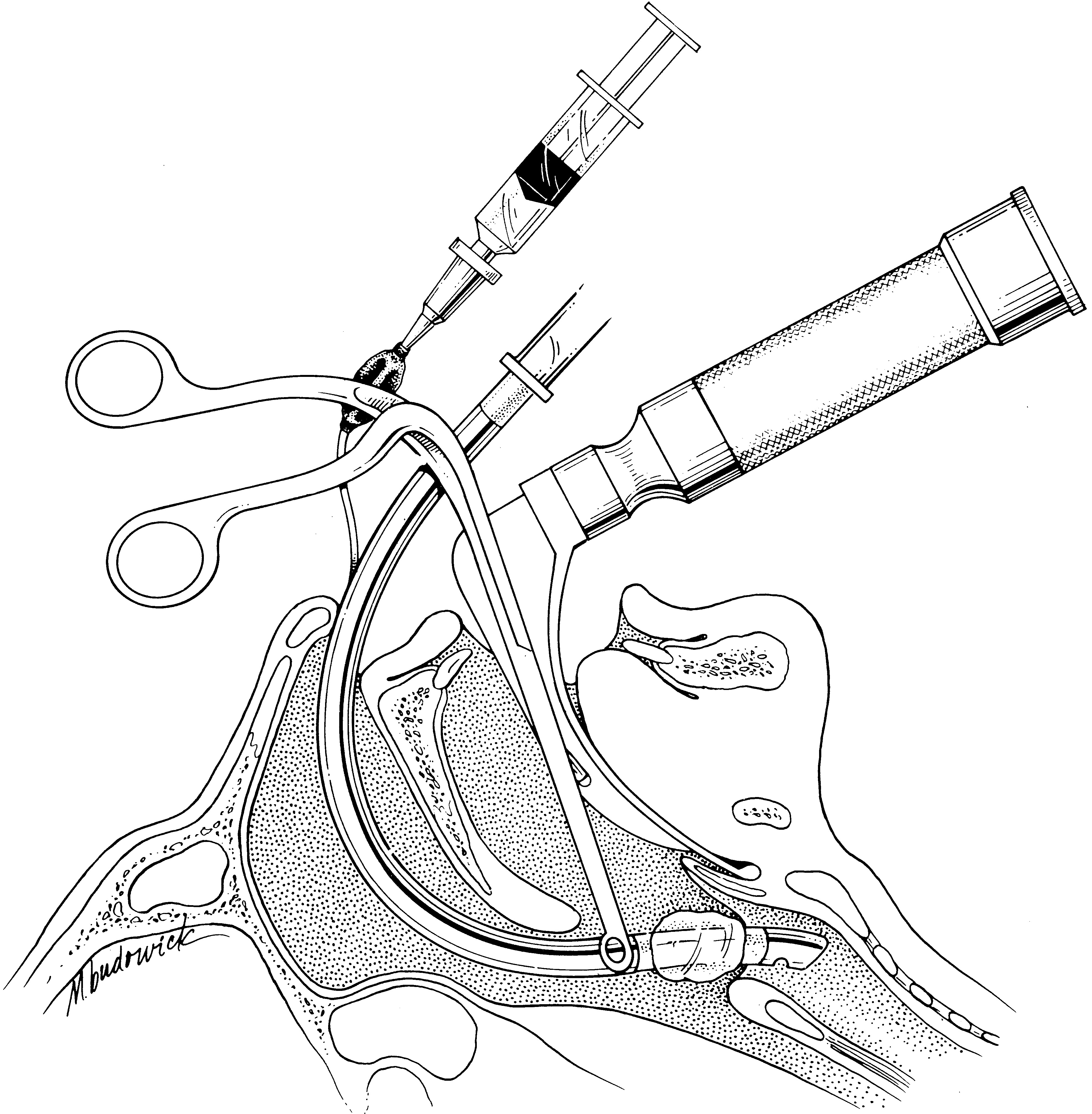 forceps Taber's Medical Dictionary