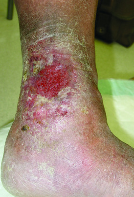 impetigo contagiosa dermatitis stasis dictionary