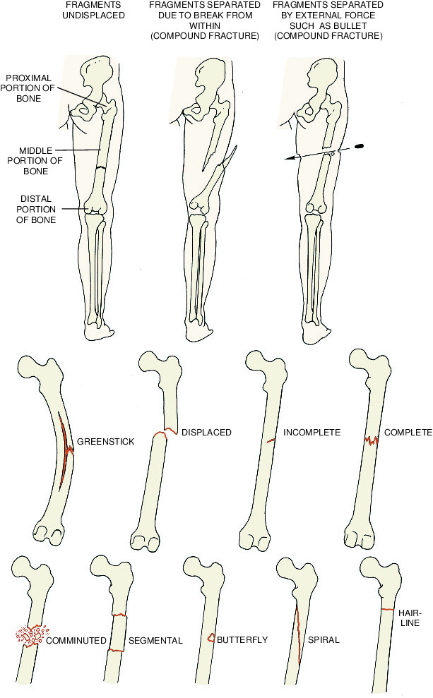 fracture Taber's Medical Dictionary