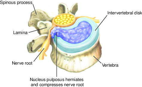 Pelvic Prolapse  Nucleus Health 