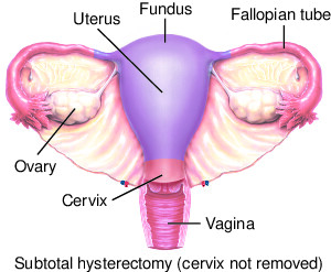 Hysterectomy