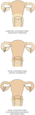 hysterectomy | Taber's Medical Dictionary