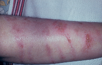 dermatitis | Taber's Medical Dictionary